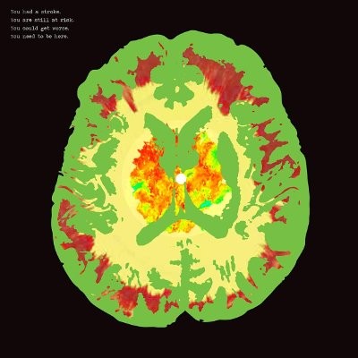 Minus 5 : Stroke Manor (LP) RSD
